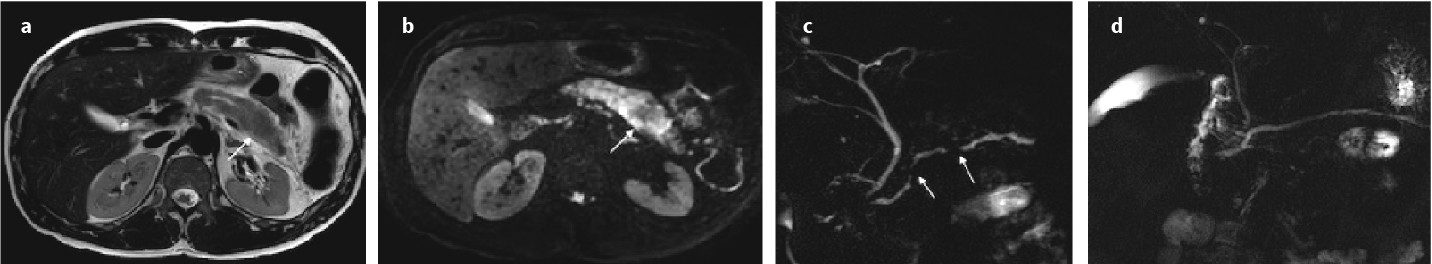 Mistakes in Pancreatobiliary Imaging Fig 5