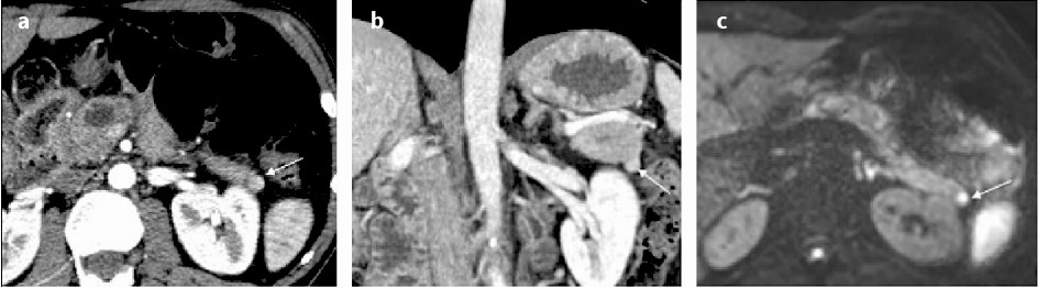 Mistakes in Pancreatobiliary Imaging Fig 6