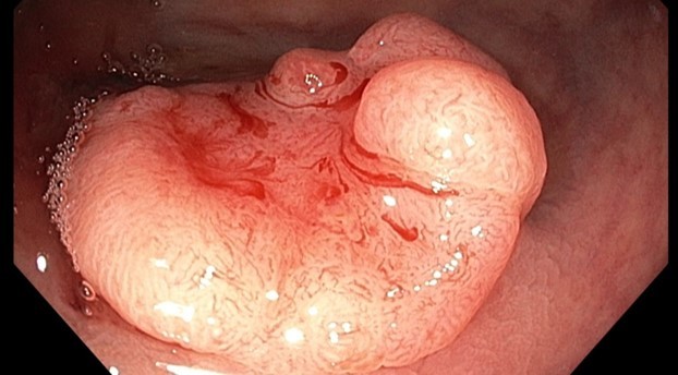 rectal cancer on colonoscopy