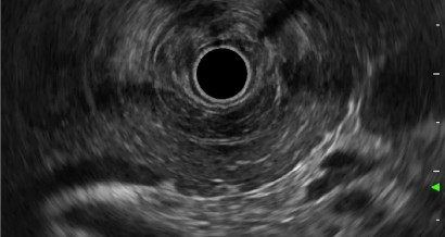 Mistakes in endoscopic ultrasonography and how to avoid them