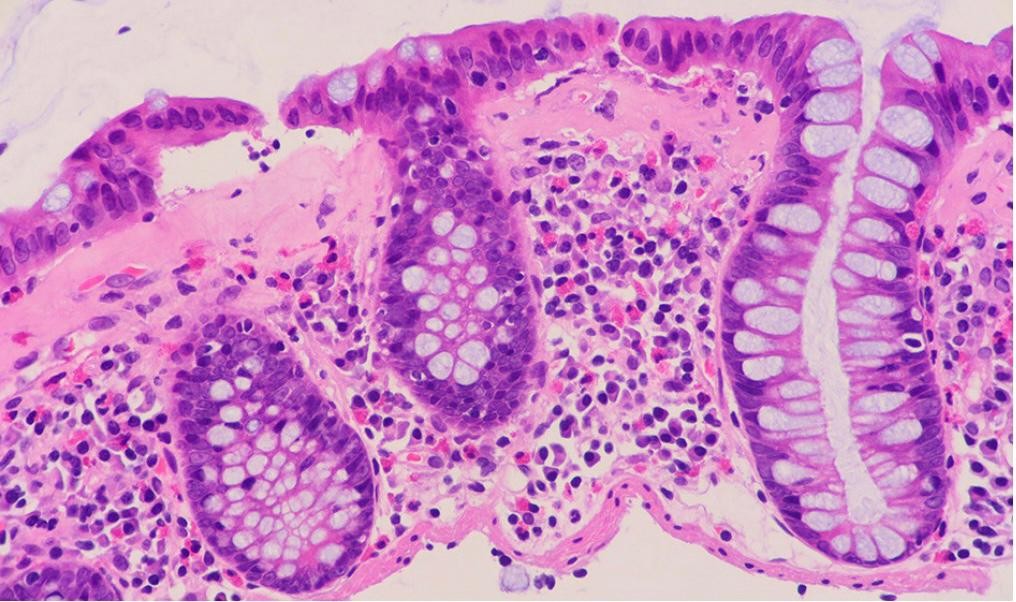 mistakes-in-microscopic-colitis-and-how-to-avoid-them-ueg-united