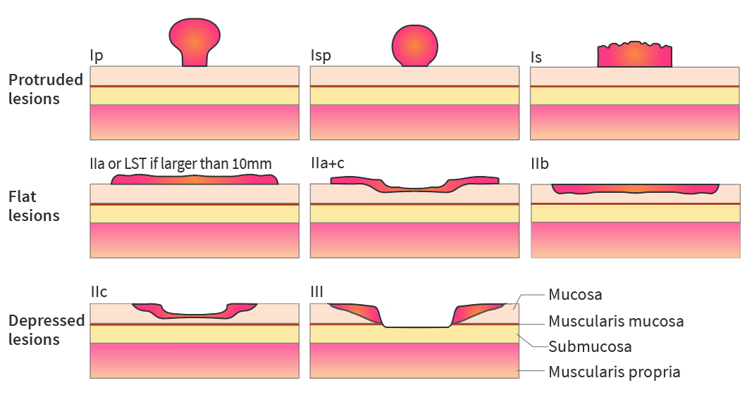 Mistakes In The Management Of Gastric Polyps And How To Avoid Them