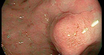 Mistakes in the management of gastric polyps and how to avoid them