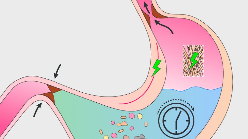 Mistakes in gastroparesis and how to avoid them