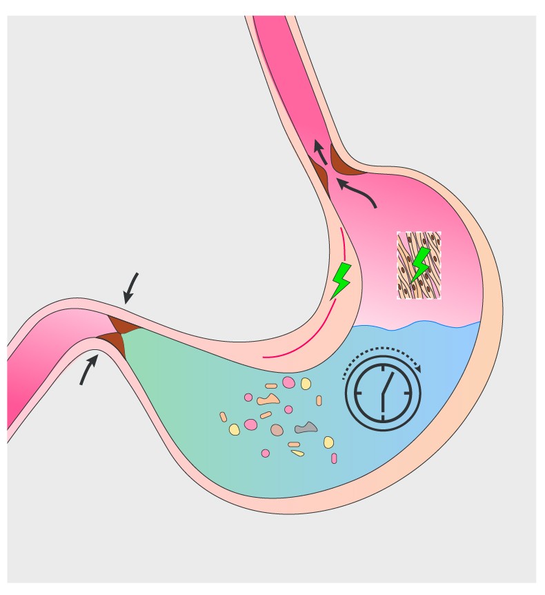 Mistakes In Gastroparesis And How To Avoid Them Ueg United European Gastroenterology 6486