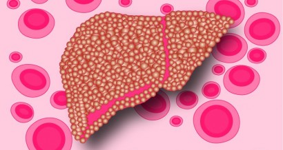 Mistakes in coagulation in liver disease and how to avoid them