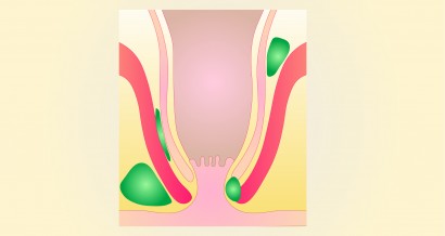 Proctology — anatomy, anal fissure and anal abscess and fistula