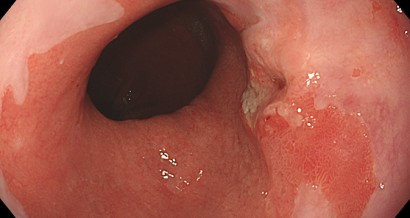 Mistakes in endoscopic treatment of Barrett oesophagus neoplasia and how to avoid them