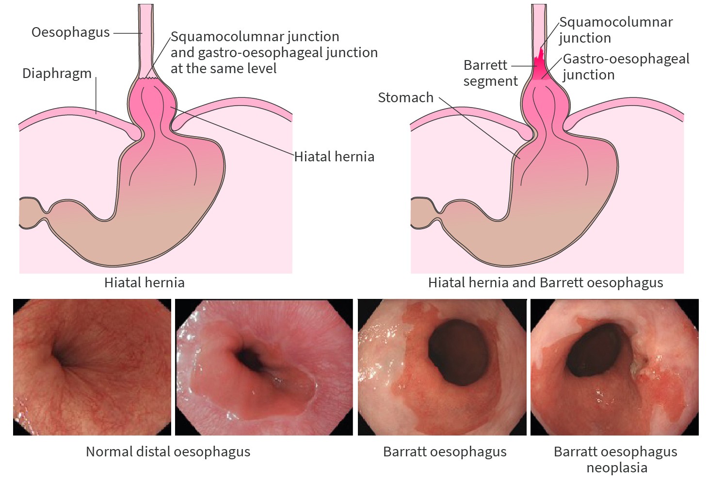 Mistakes in endoscopic treatment of Barrett oesophagus neoplasia and