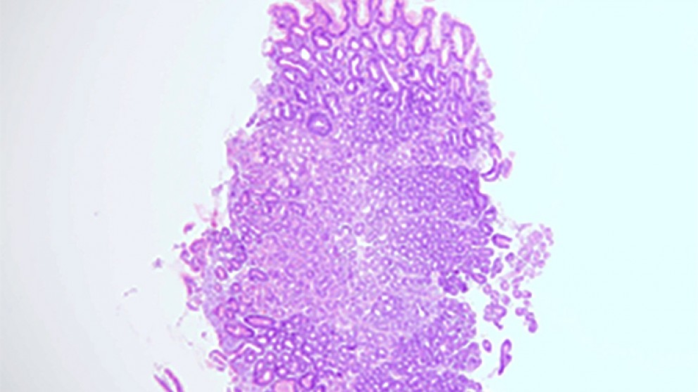 Mistakes in the management of chronic gastritis and how to avoid them