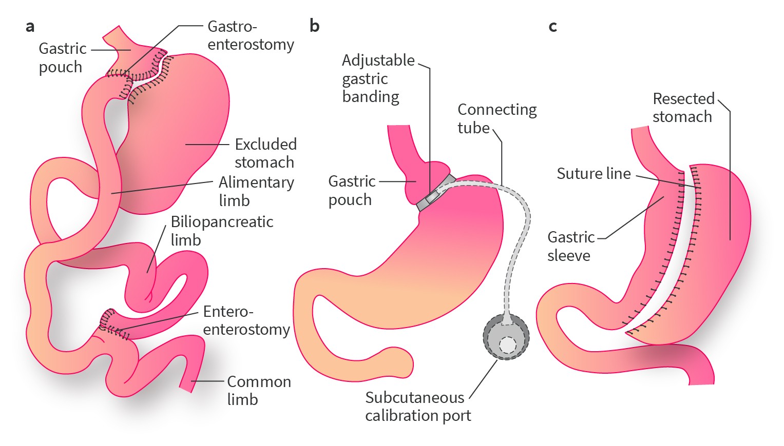 Mistakes In Bariatric Surgery And How To Avoid Them Ueg United European Gastroenterology