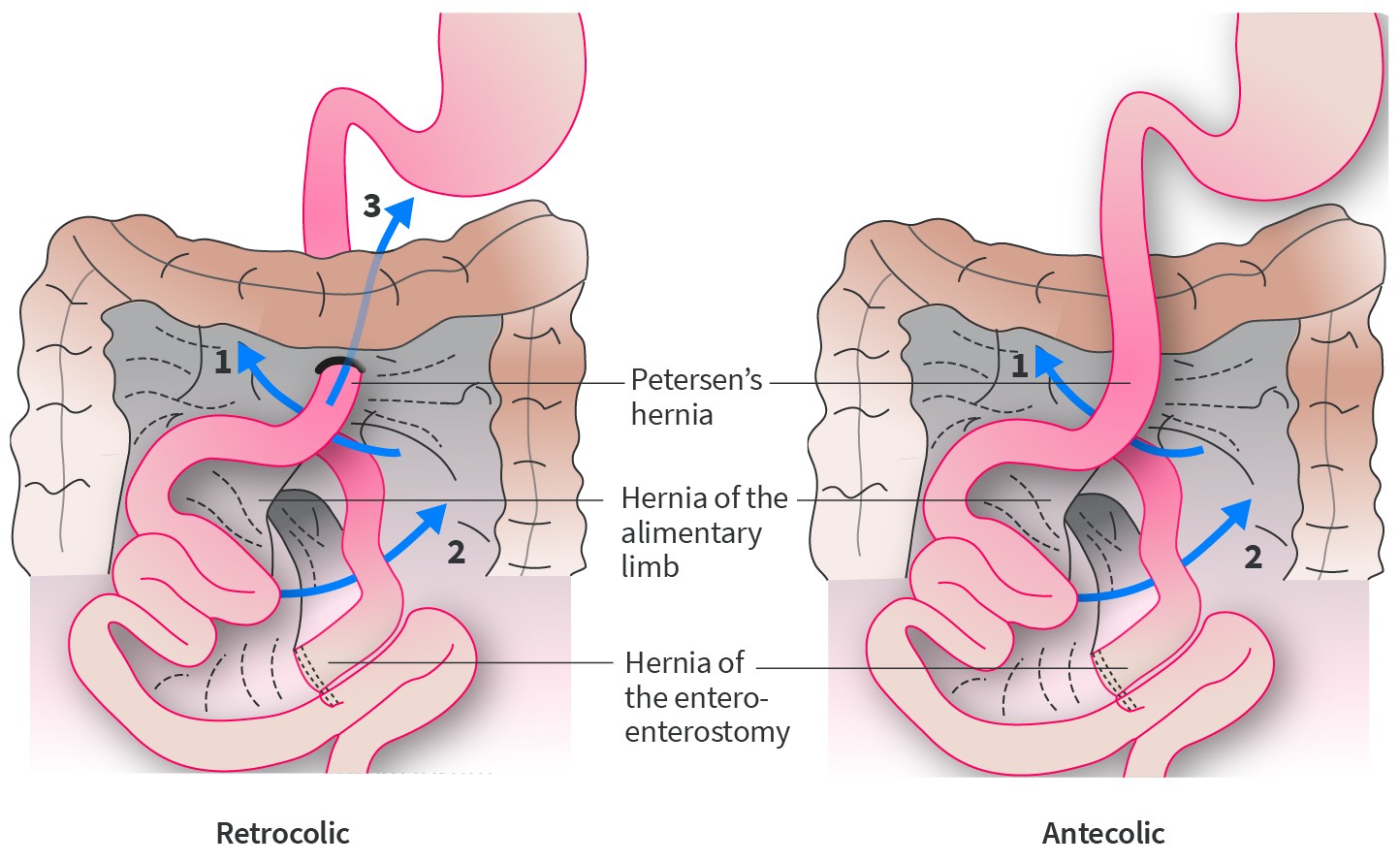 Mistakes In Bariatric Surgery And How To Avoid Them Ueg United European Gastroenterology