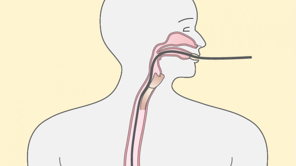 Mistakes in gastroscopy and how to avoid them