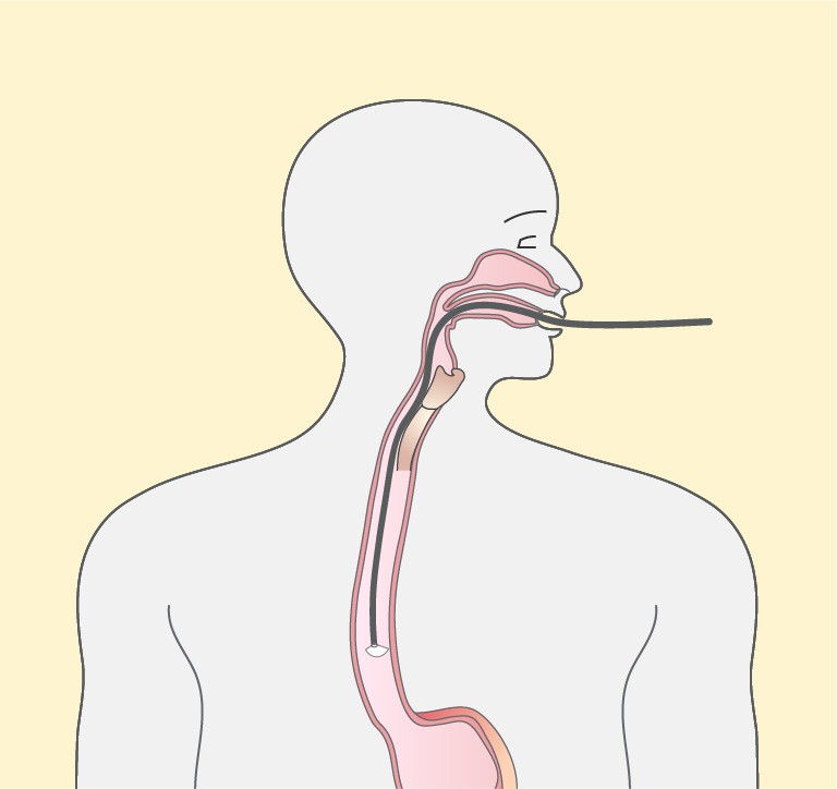 mistakes-in-gastroscopy-and-how-to-avoid-them-ueg-united-european