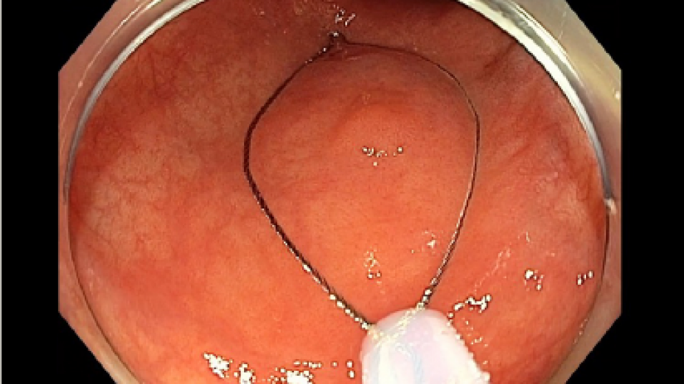 Mistakes in polypectomy and how to avoid them