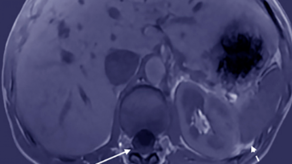 Mistakes in imaging hepatic lesions and how to avoid them