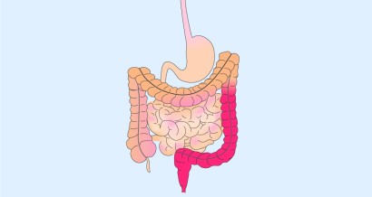 Mistakes in acute severe ulcerative colitis and how to avoid them