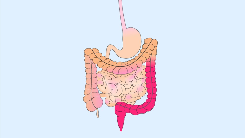 Mistakes in acute severe ulcerative colitis and how to avoid them