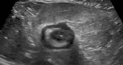 Mistakes in gastrointestinal ultrasound and how to avoid them