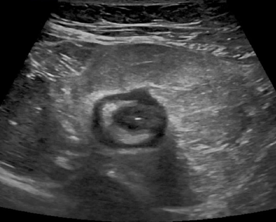 Mistakes in gastrointestinal ultrasound and how to avoid them