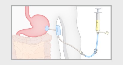 Mistakes in gastrostomy insertion and how to avoid them