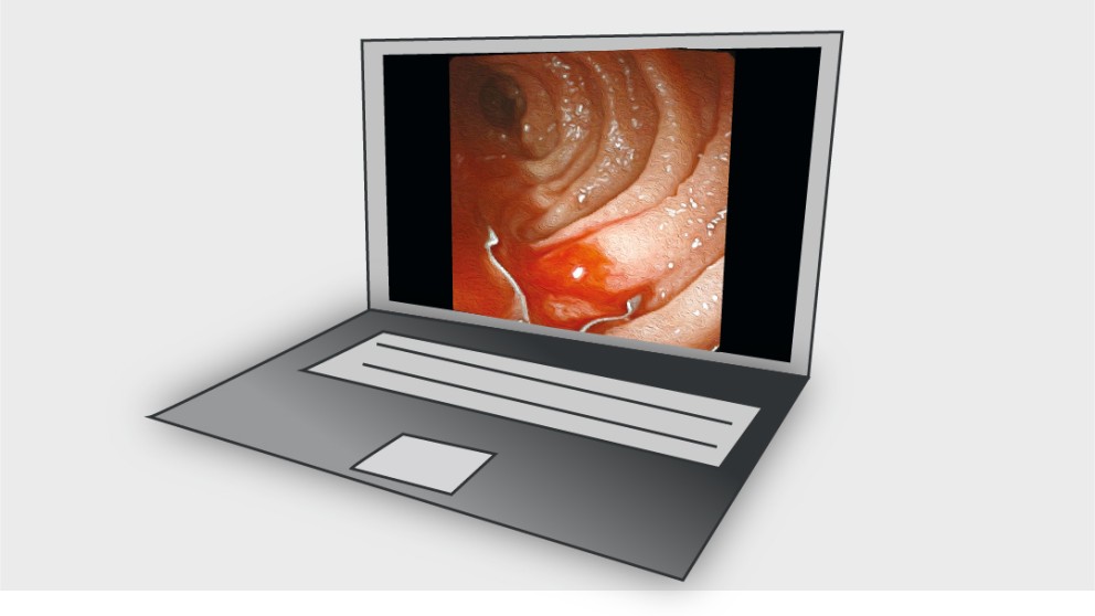 Mistakes in small bowel bleeding and how to avoid them