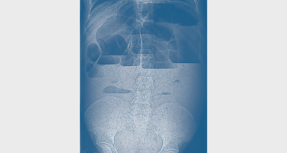 Mistakes in chronic intestinal pseudo-obstruction and how to  avoid them