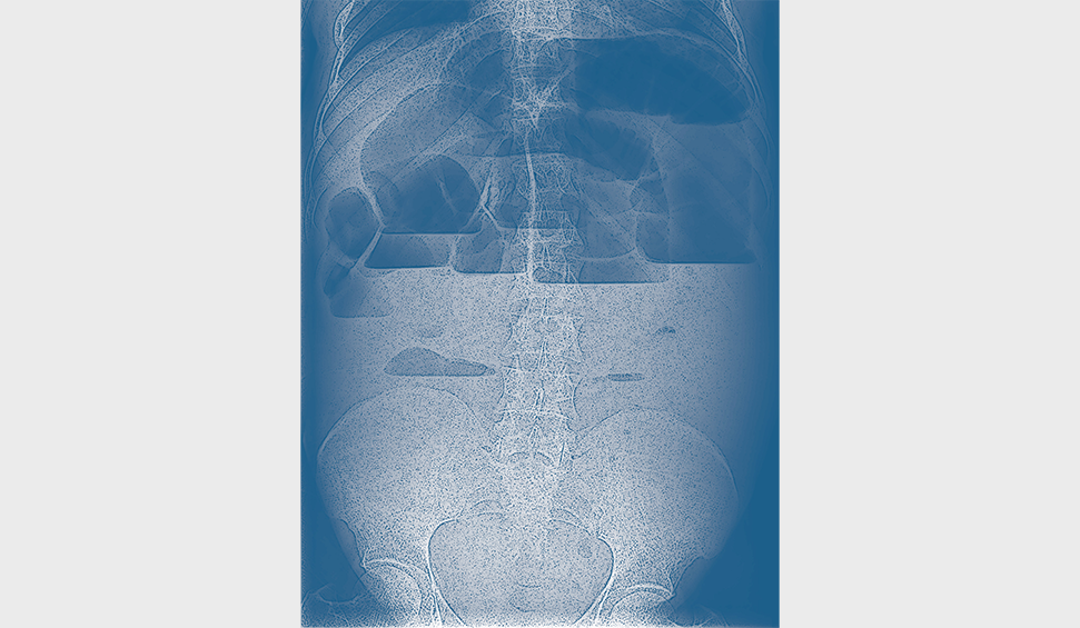 Mistakes in chronic intestinal pseudo-obstruction and how to avoid them