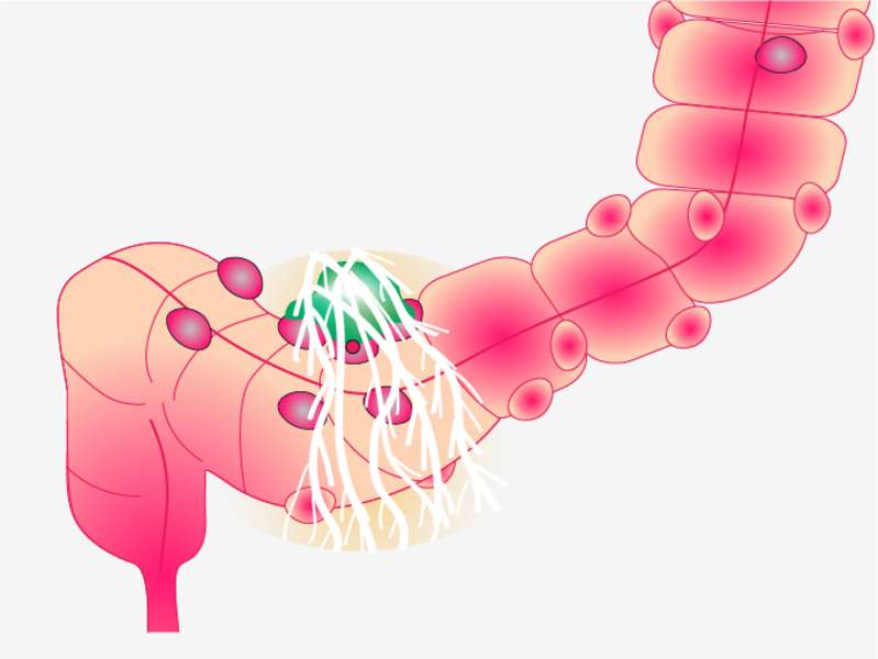 Mistakes in acute diverticulitis and how to avoid them UEG United