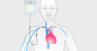 Mistakes in intestinal failure and parenteral nutrition and how to avoid them