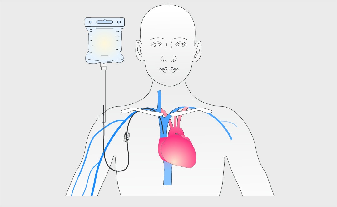 Mistakes in intestinal failure and parenteral nutrition and how to avoid them