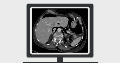 Mistakes in acute abdominal CT and how to avoid them