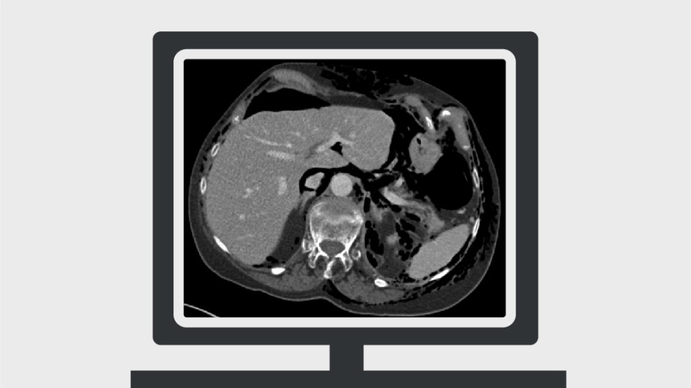 Mistakes in acute abdominal CT and how to avoid them