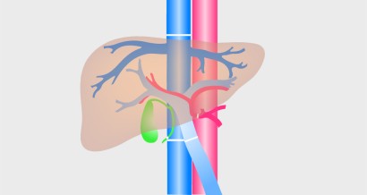 Mistakes in liver transplantation and how to avoid them