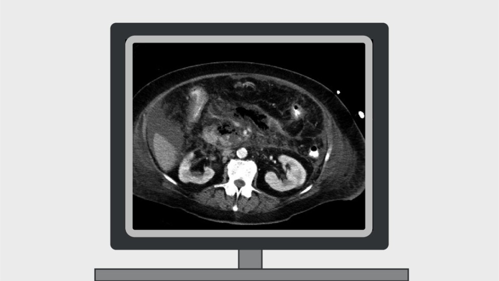 Mistakes in the management of acute pancreatitis and how to avoid them