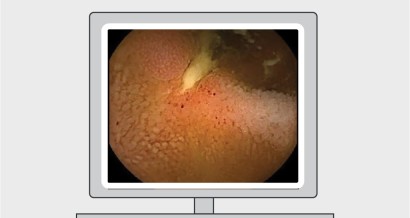 Mistakes in capsule endoscopy and how to avoid them