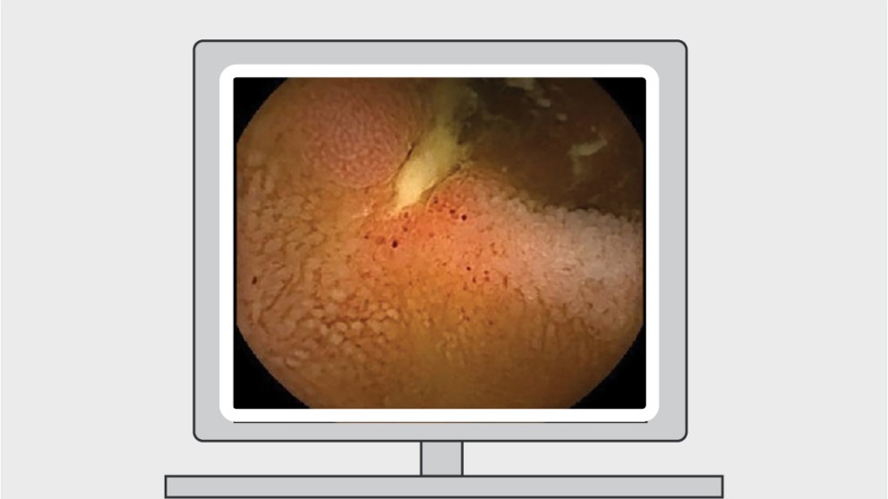 Mistakes in capsule endoscopy and how to avoid them
