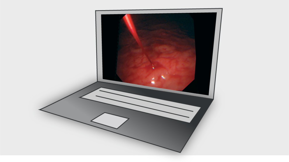 Mistakes in upper gastrointestinal bleeding and how to avoid them