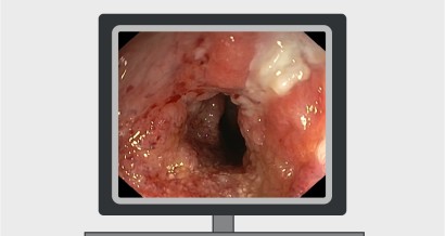 Mistakes in endoscopic treatment of Barrett oesophagus neoplasia and how to avoid them