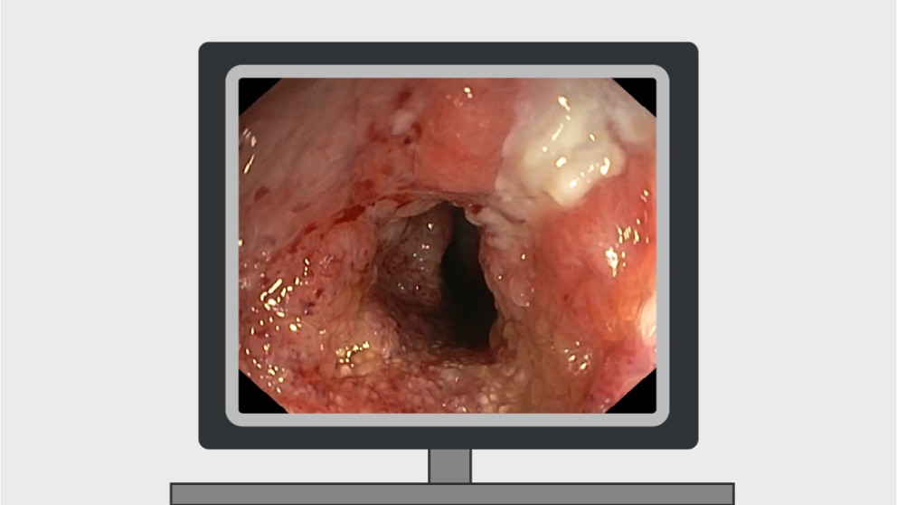 Mistakes in endoscopic treatment of Barrett oesophagus neoplasia and how to avoid them