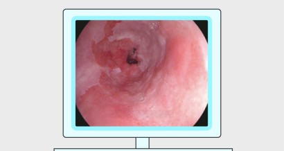 Mistakes in the endoscopic diagnosis and management of Barrett’s oesophagus and how to avoid them