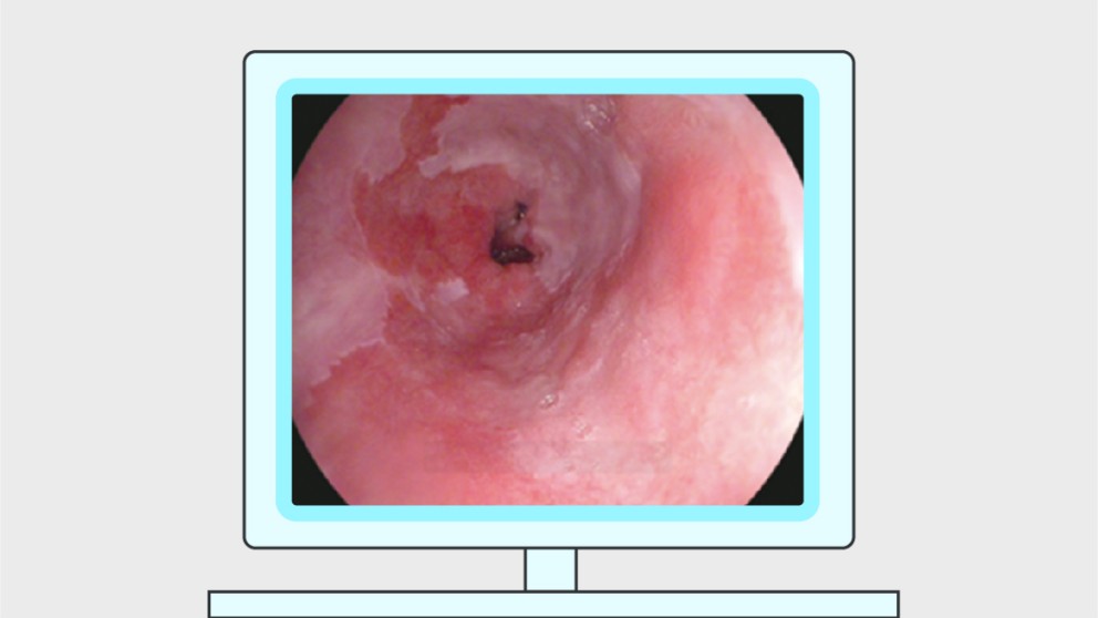 Mistakes in the endoscopic diagnosis and management of Barrett’s oesophagus and how to avoid them