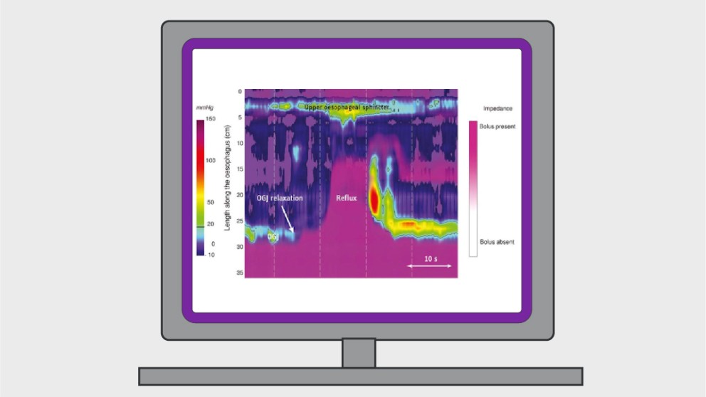 Mistakes in gastro-oesophageal reflux disease diagnosis and how to avoid them