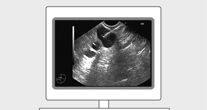 Mistakes in pancreatic cystic neoplasms and how to avoid them