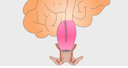 Mistakes in pouchitis and how to avoid them