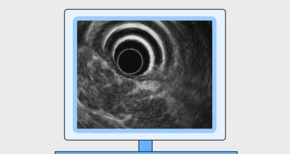 Mistakes in endoscopic ultrasonography and how to avoid them