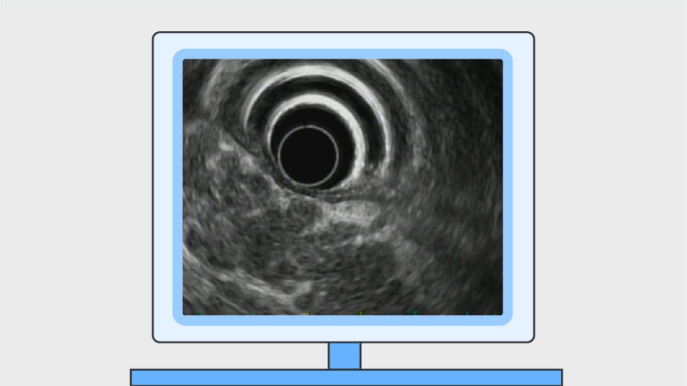 Mistakes in endoscopic ultrasonography and how to avoid them