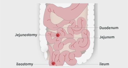 Mistakes in short bowel and how to avoid them