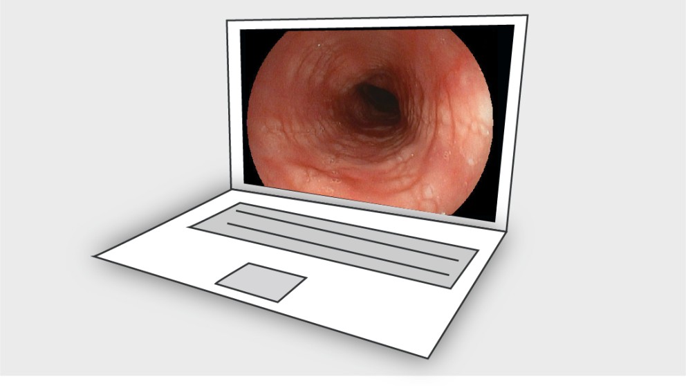 Mistakes in eosinophilic oesophagitis and how to avoid them