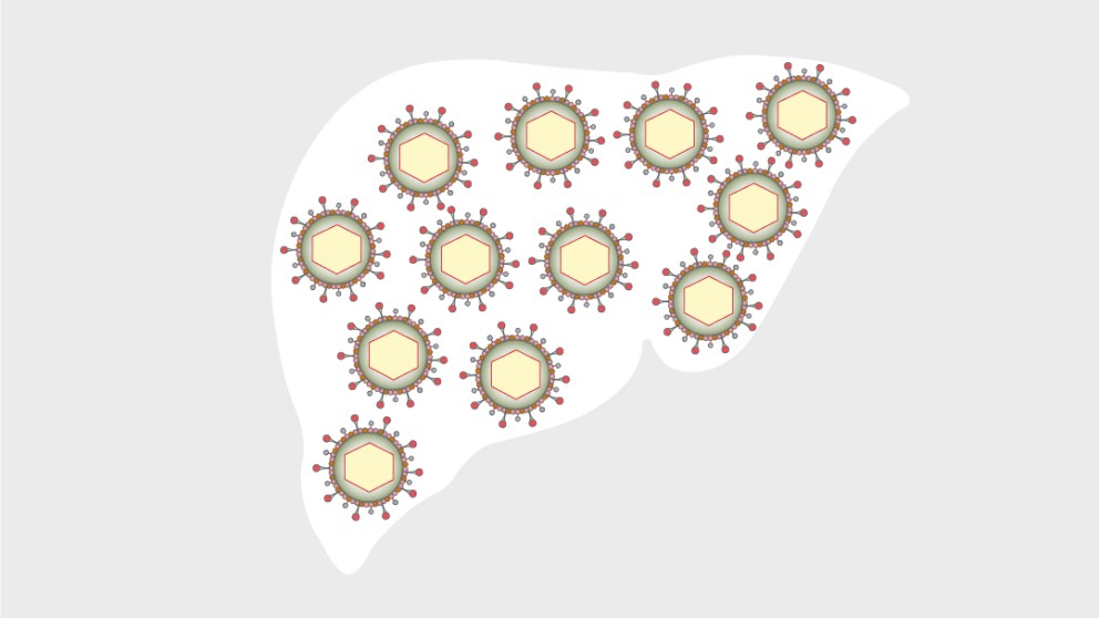 Mistakes in chronic hepatitis B management and how to avoid them